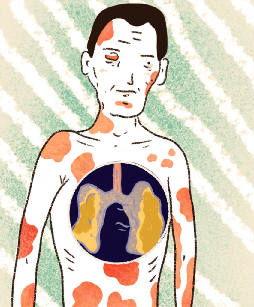 La IARC clasifica el glifosato como probablemente carcinógenico para humanos